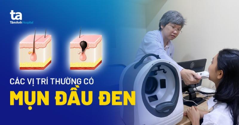 Cấu tạo của mụn đầu đen và cơ chế hình thành trong lỗ chân lông